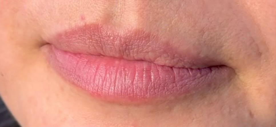 Antes — Preenchimento labial