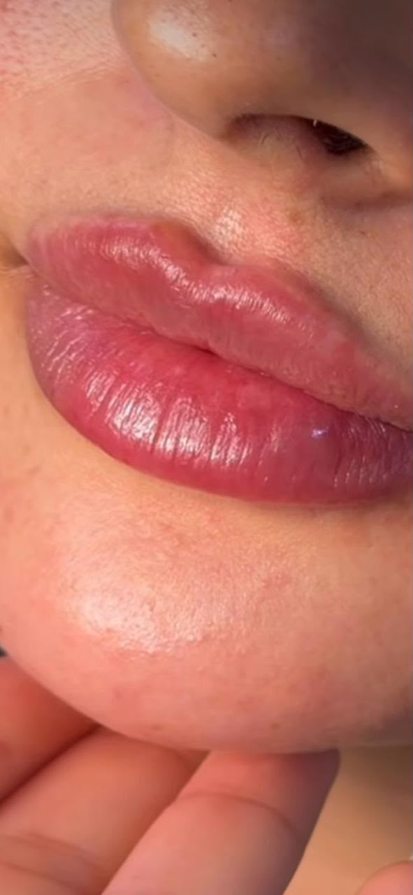 Depois — Preenchimento labial